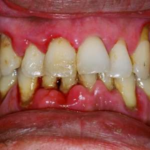 Periodontal Treatment