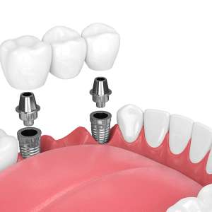 Dental Bridge