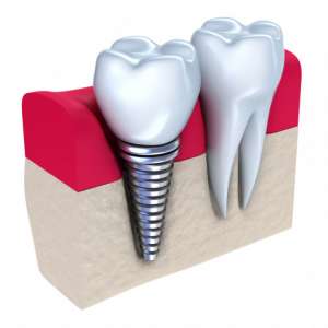 Dental Implants