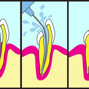 Root Canal