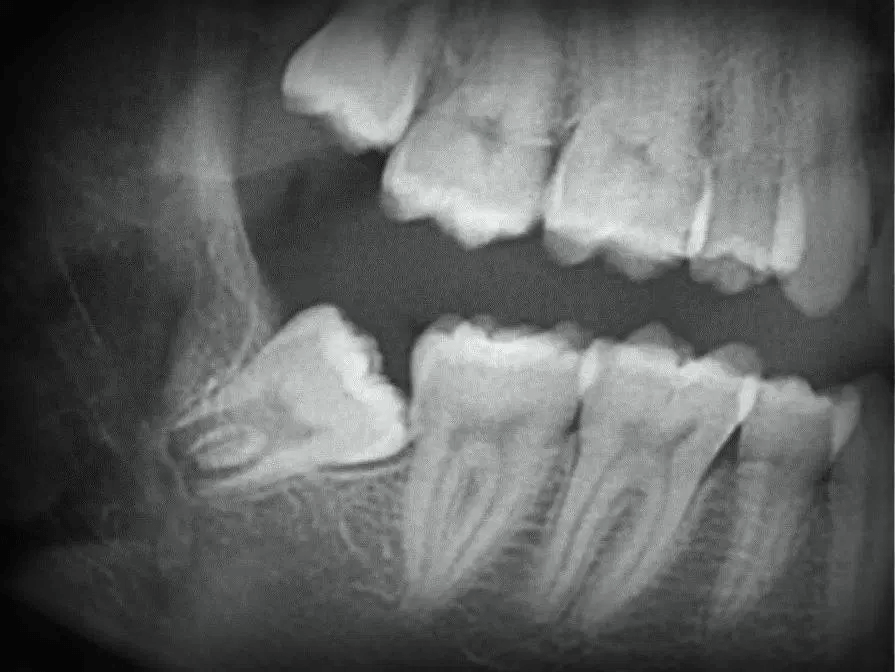 Wisdom tooth xray