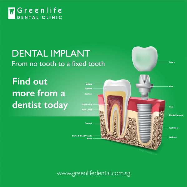 dental implant