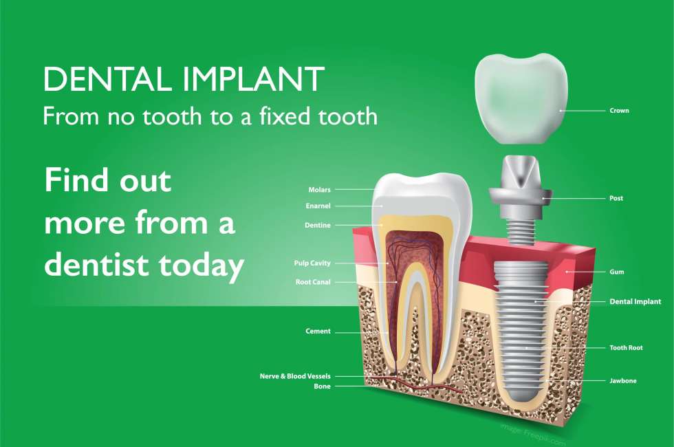 dental implant