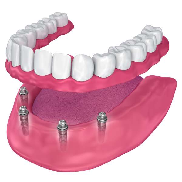 recommended dental implant dentist