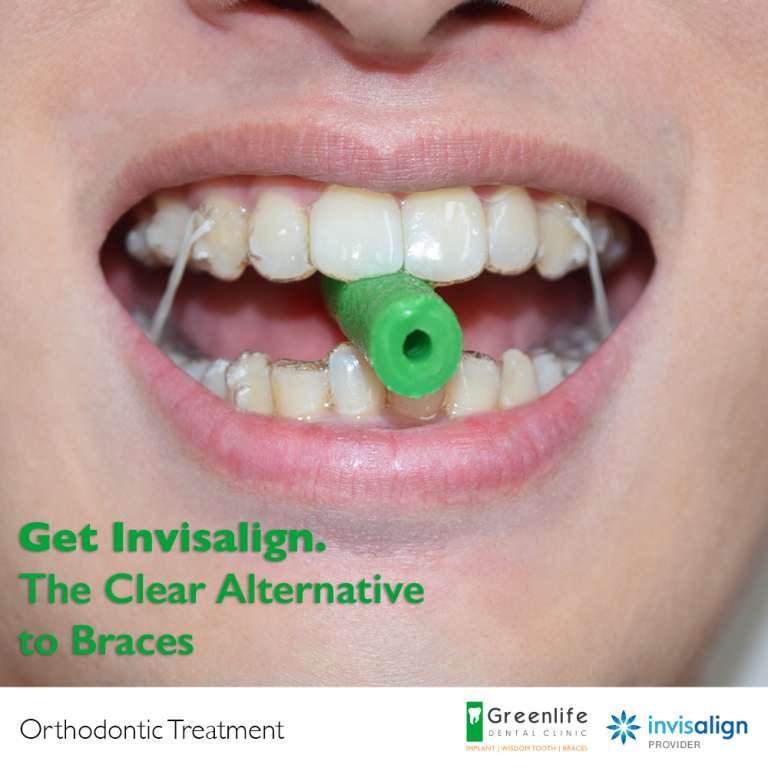What are Invisalign Chewies and what do they do? Greenlife Dental