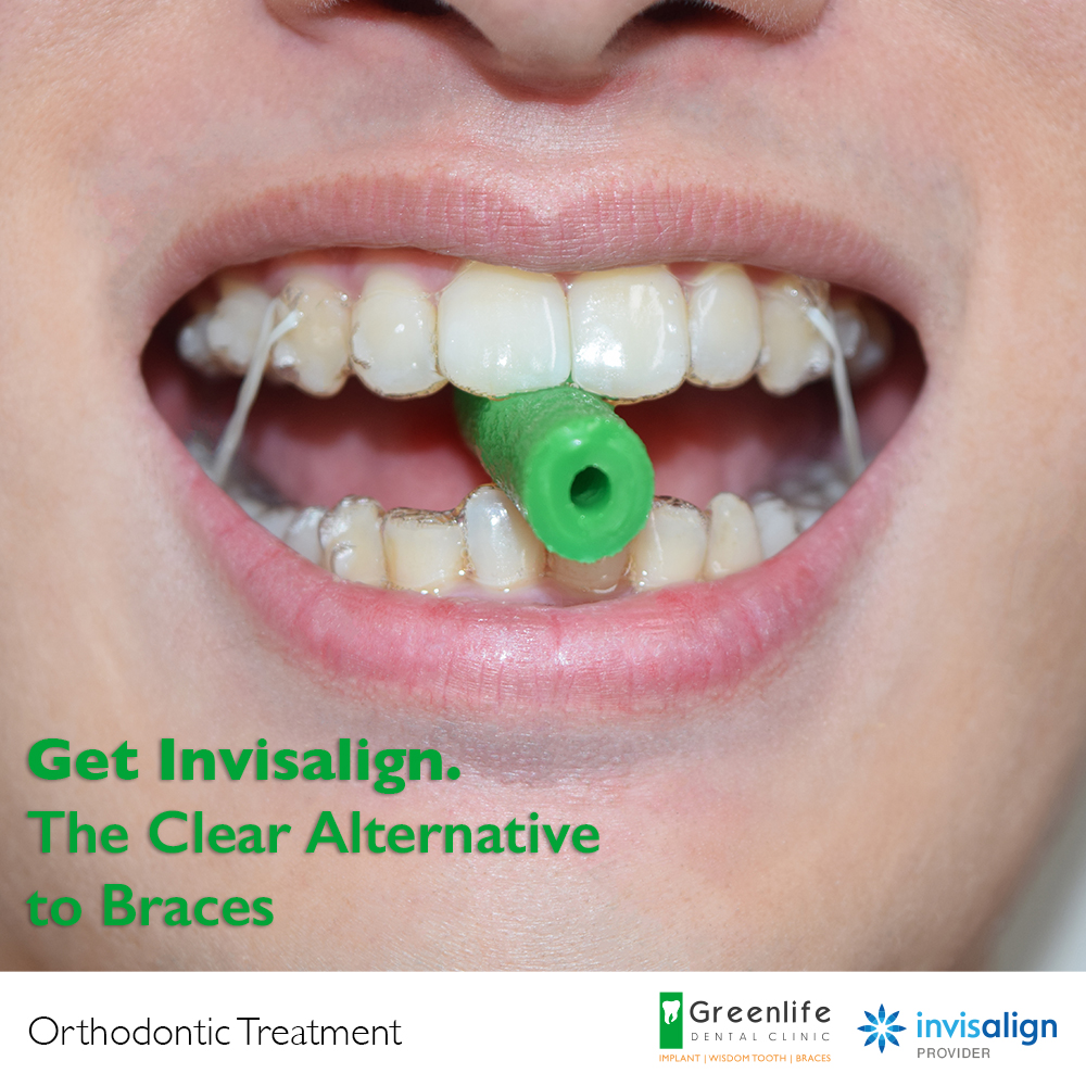 What are Invisalign Chewies and what do they do Greenlife Dental