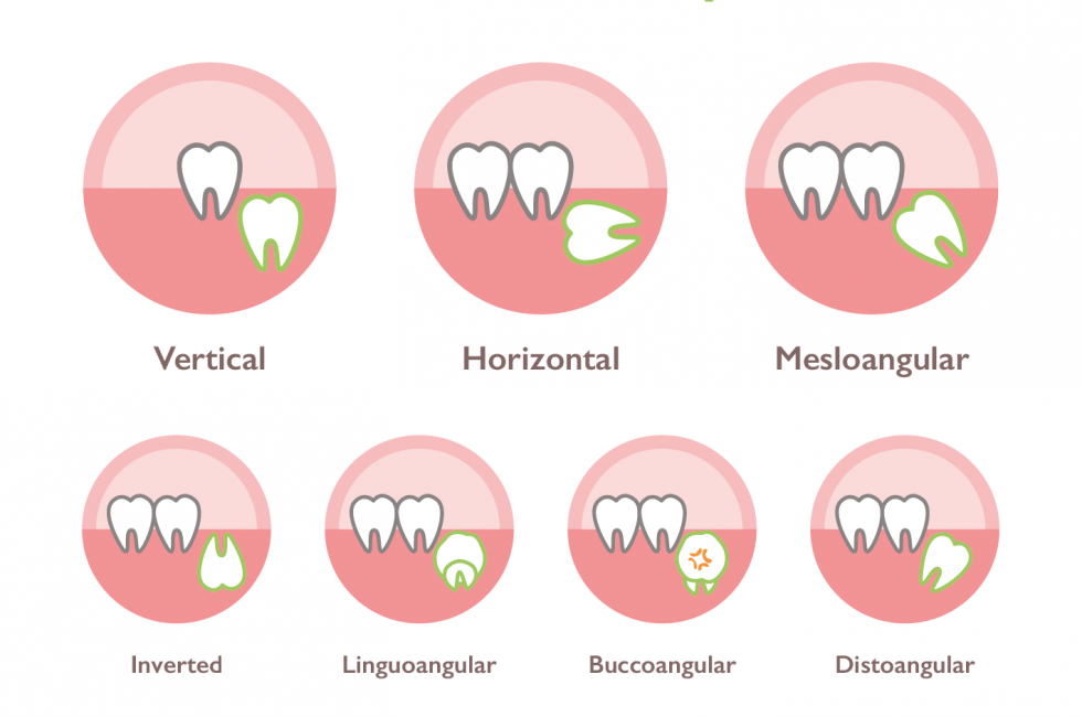 impacted wisdom tooth