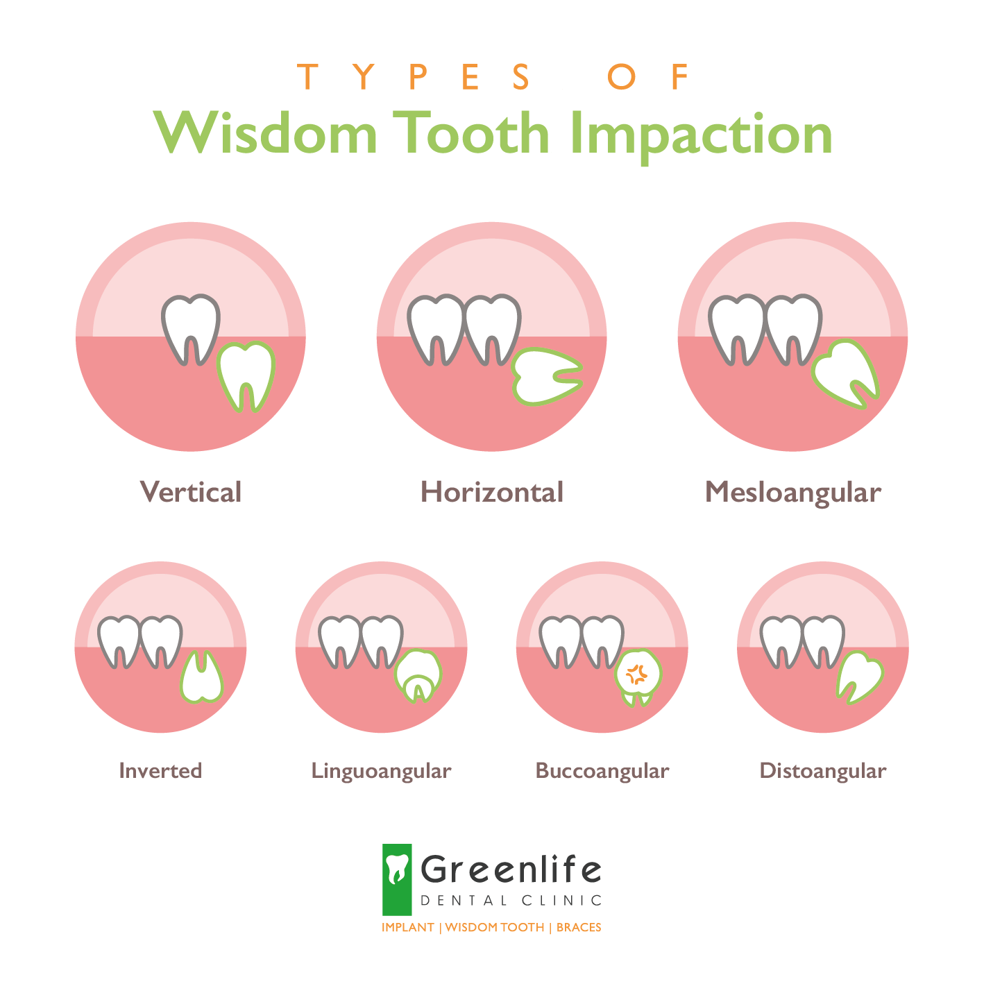 What Are The Different Kinds Of Wisdom Tooth Impaction Greenlife Dental