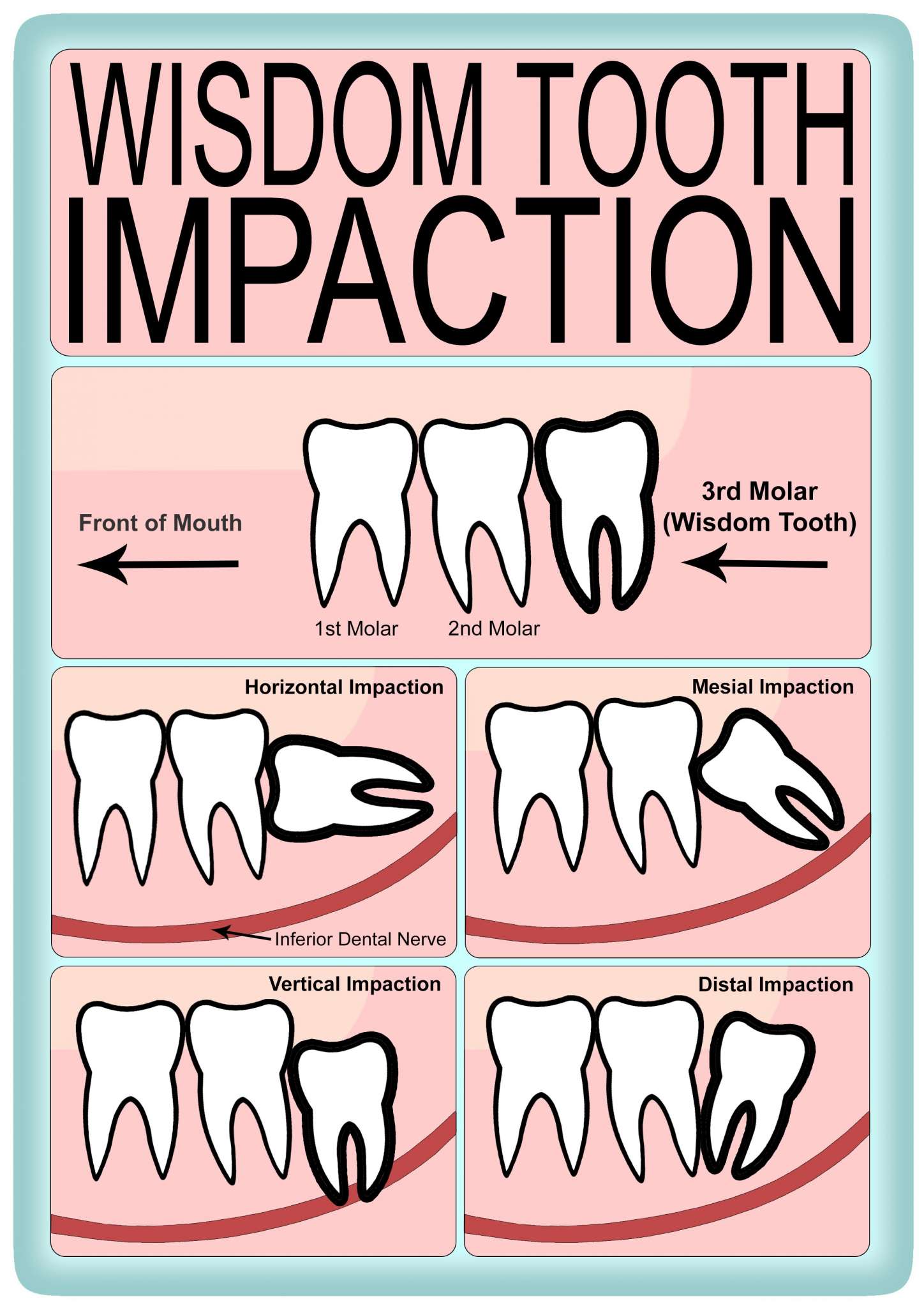 wisdom tooth essay