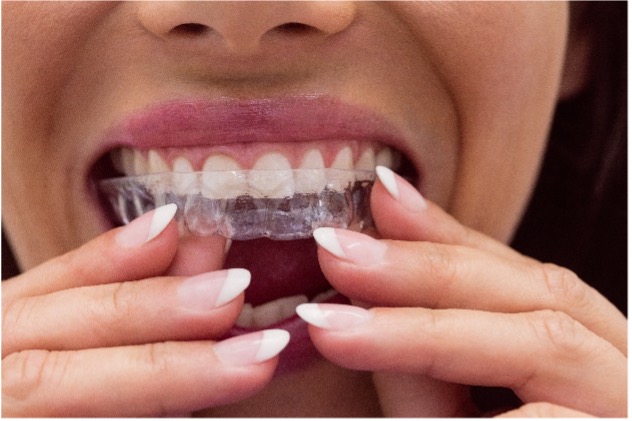 Are invisible aligners as effective as fixed braces