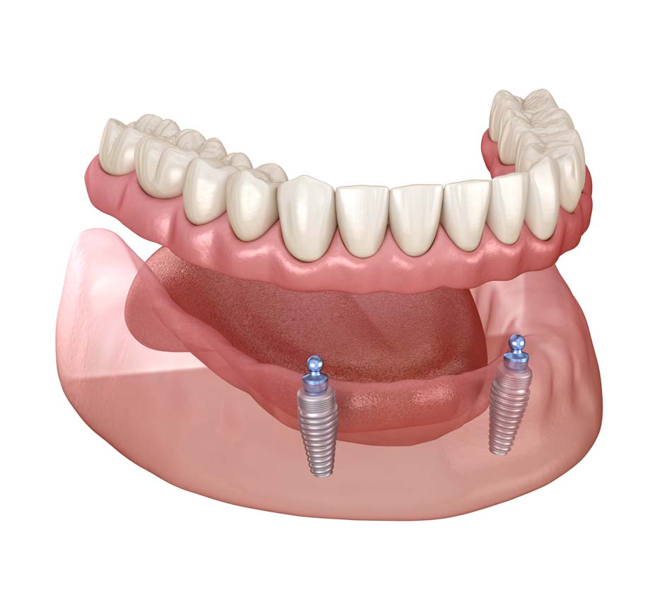 2 implants supporting 10 teeth