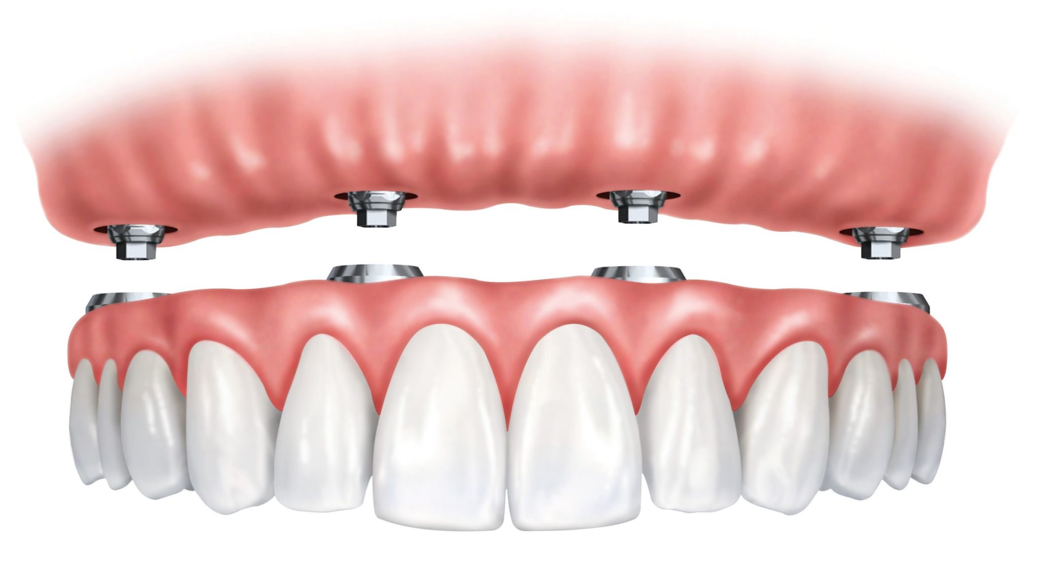 4 implants supporting 11-teeth upper denture