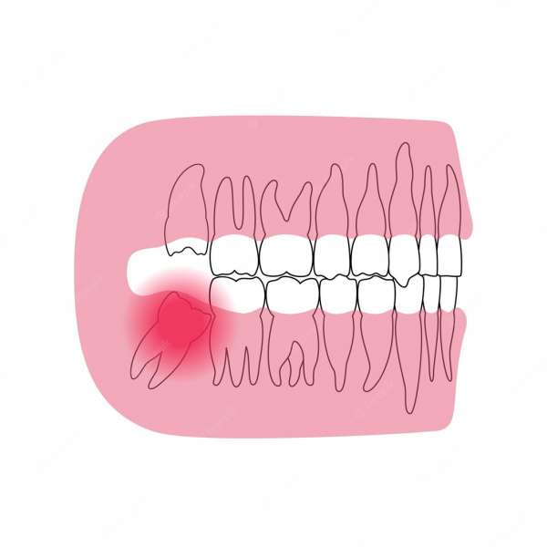 impacted wisdom tooth