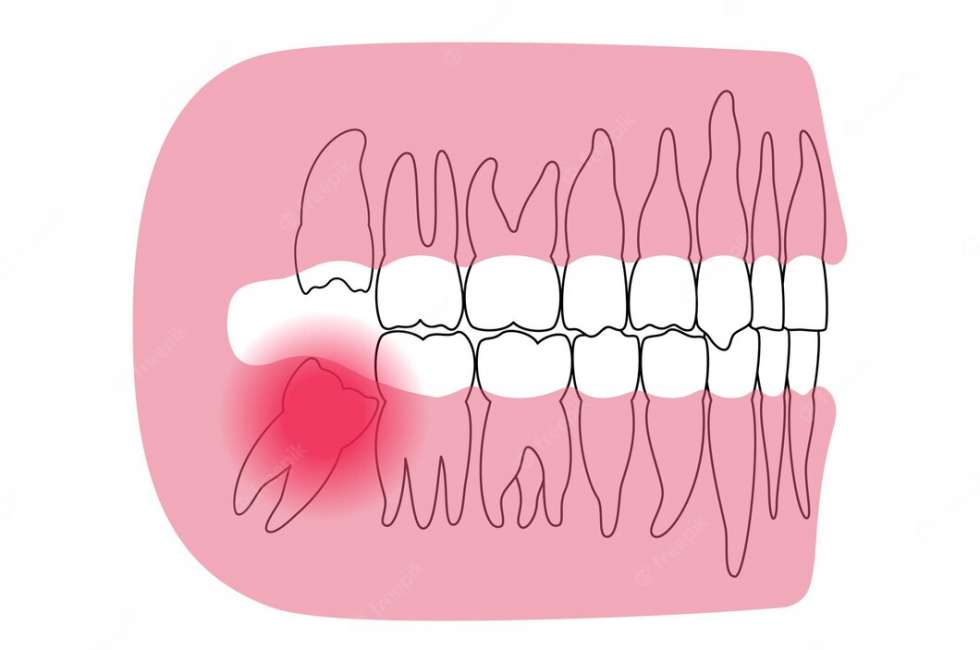 impacted wisdom tooth