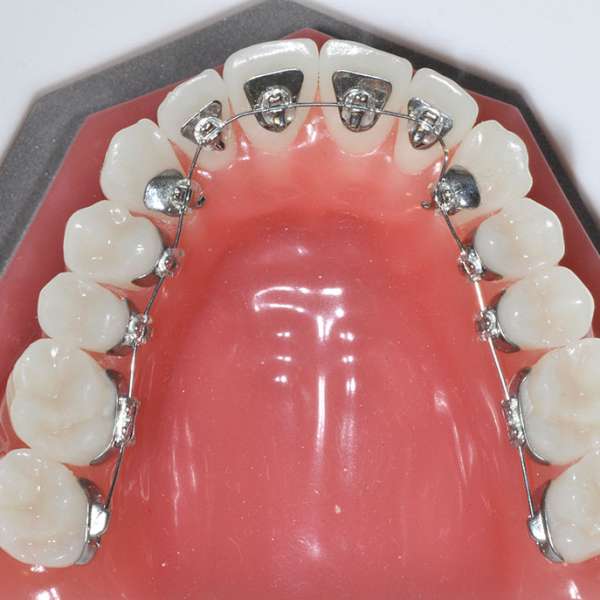 lingual braces