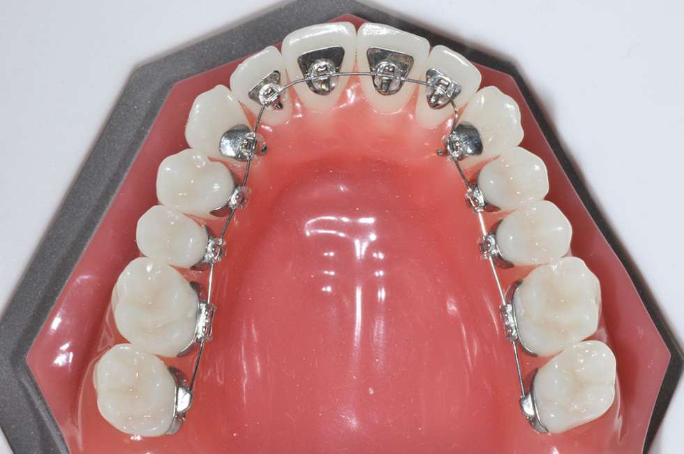 lingual braces